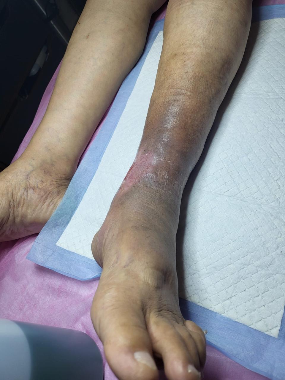 Diabetic foot care